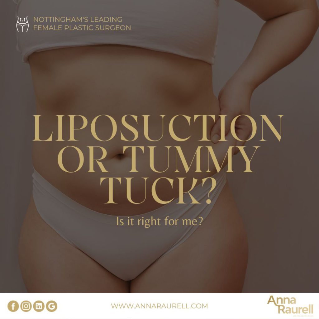 Liposuction or a tummy tuck - Anna Raurell