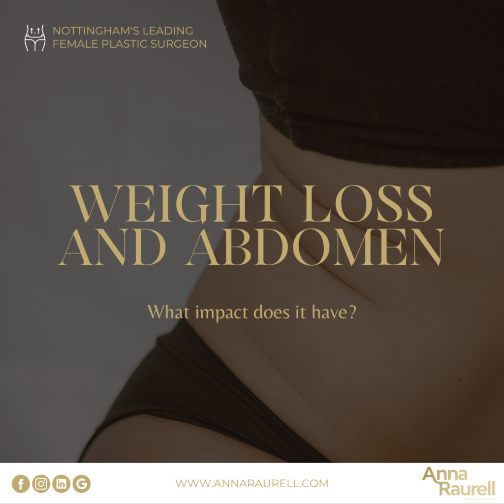 Weight loss and abdomen - Anna Raurell - Cosmetic Surgery